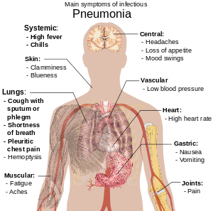 Pnömaninin başlıca belirtilerini gösteren bir insan vücudu diyagramı