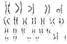 Karyotype of 47, XXY. The only difference for 48, XXXY would be a third X chromosome.