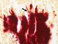 Actinomycosis - Gram stain (5286050326).jpg