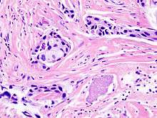 Histopathology of invasive ductal carcinoma of the breast representing a scirrhous growth.
