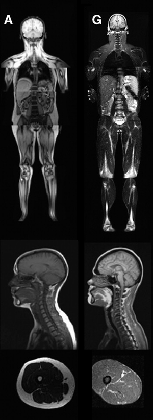 MRI of control patient vs. diseased patient.