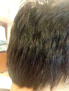 Severe dryness of scalp resulting in Dandruff.