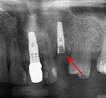 Fracture implant