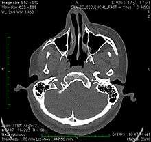 A CT image of the head of a 17-year-old girl with Parry–Romberg syndrome, showing atrophy of the subcutaneous tissue and underlying muscle, with no apparent involvement of the bone structure.