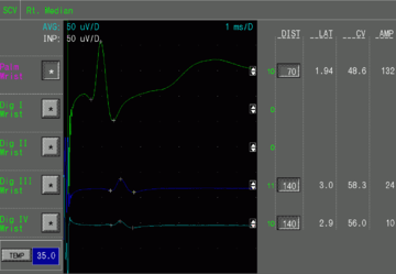 An example screenshot showing the results of a sensory nerve conduction velocity study
