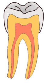 Animated image showing the shape progression of a caries lesion in the cervical region of a tooth.