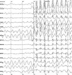 An electroencephalogram of a person with childhood absence epilepsy showing a seizure. The waves are black on a white background.