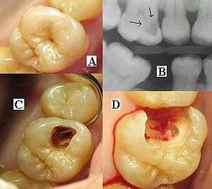 Montage of four pictures: three photographs and one radiograph of the same tooth.