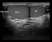 Ultrasound scan of Type A3 polyorchidism