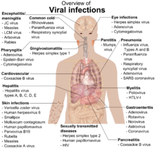 A photograph of the upper body of a man labelled with the names of viruses that infect the different parts