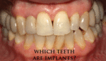 Mouth with many implant supported teeth where it is difficult to distinguish the real teeth from the prosthetic teeth.